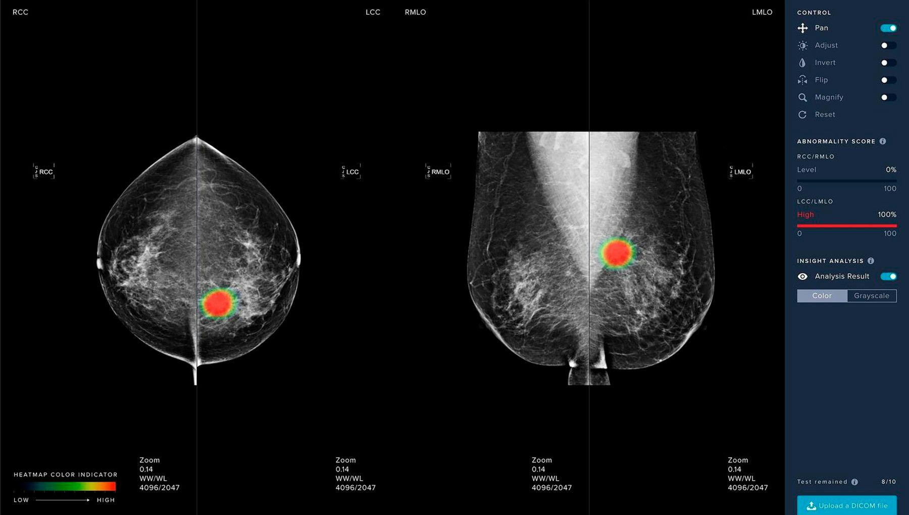 AI-assisted medical imaging for breast cancer