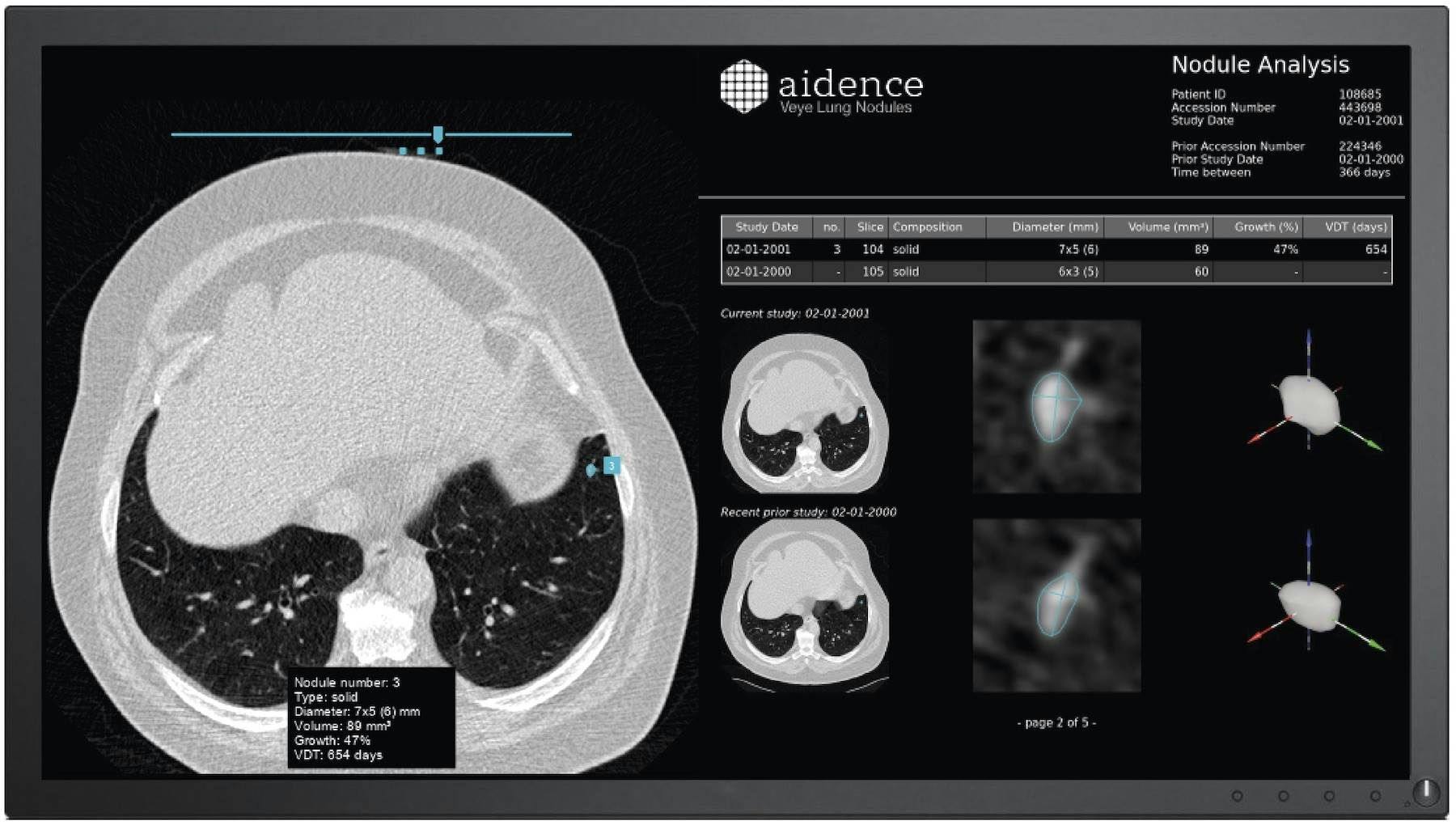 Chest scan to identify nodules with AI